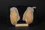 Sclérodactylie avec déformations articulaires et altérations des ongles. Femme âgée de 47 ans, emplo [...]