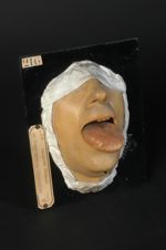 Glossite syphilitique tertiaire scléro-gommeuse. Homme âgé de 40 ans, employé