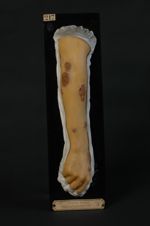 Eczéma croûteux en plaques. Femme, couturière