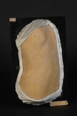 Lichen plan du tronc (moulage très décoloré, Inv.1922). Homme âgé de 16 ans, bijoutier. Lichen ruber