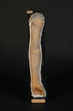 Ichtyose. Garçon âgé de 12 ans