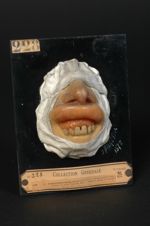 Lupus tuberculeux des gencives et du nez. Homme âgé de 29 ans, homme de peine