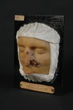 Épithéliome (Inv. 1889) baso-cellulaire du nez ou syphilide tertiaire ulcéreuse serpigineuse ; diagn [...]