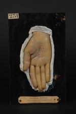 Syphilides palmaires psoriasiformes probables (Inv. 1922). Femme âgée de 31 ans, couturière. Psorias [...]