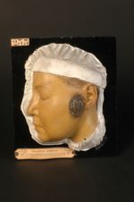 Gomme syphilitique de la joue, couverte d'une croûte à forme de rupia. Femme âgée de 36 ans, coloris [...]