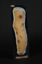 Ecthyma à forme de rupia, aux différents degrés de son développement. Homme âgé de 29 ans, cocher