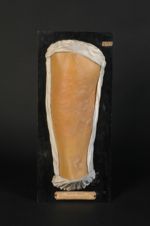 Urticaire de la cuisse. Homme âgé de 29 ans, cocher