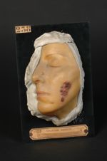 Lupus tuberculeux ulcéreux de la joue et du cou. Femme âgée de 39 ans, domestique (V. le n° 232, voû [...]