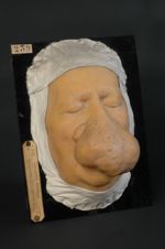 Acné hypertrophique du nez. Syn. : Rhinophyma, variété pachydennique (Inv. 1889)