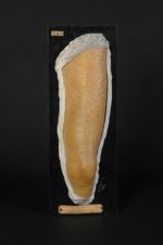 Erythème papuleux copahique (moulage en partie décoloré, Inv. 1922). Homme âgé de 27 ans, mécanicien