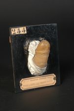 Induration de l'urèthre, d'origine syphilitique. Homme âgé de 36 ans ; canneleur