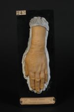 Erythème polymorphe marginé. Femme âgée de 58 ans, blanchisseuse