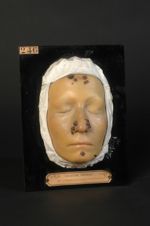 Syphilide pustulo-crustacée de la face. Femme âgée de 28 ans, couturière
