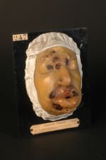 Syphilide tuberculeuse ulcérée de la face. Femme âgée de 37 ans, journalière