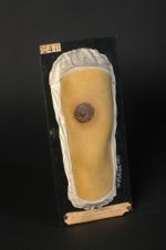 Gomme syphilitique ulcérée du bras, simulant une croûte de rupia (Inv. 1889). Rupia syphilitique. Ho [...]