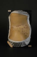 Plaques syphilitiques pigmentées de la peau. Roséole syphilitique du tronc. Femme âgée de 28 ans, fl [...]