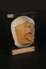 Chancre syphilitique de la langue ; syphilides papuleuses concomitantes. Homme âgé de 35 ans, journa [...]