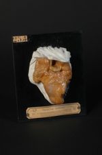 Ulcérations tuberculeuses de la langue, de l'épiglotte et du larynx (Reproduction de la pièce anatom [...]