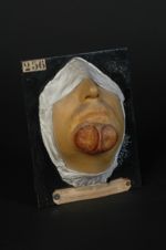 Chancre syphilitique double du menton