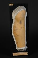 Lichen plan de la jambe : forme agminée, période pigmentaire