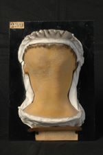 Trichophytie du cuir chevelu, pilaire et épidermique. Garçon âgé de 7 ans