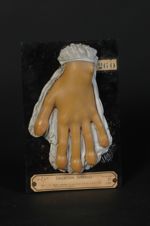 Doigts spatules chez une femme phtisique