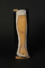 Sarcomatose de Kaposi (Inv. 1922). Sarcomatose généralisée, sarcome fasciculé érectile. Homme âgé de [...]