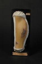 Lésions de cause artificielle. Femme âgée de 22 ans, cuisinière (Inv. 1922). Lésions trophiques. Bul [...]