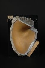 Syphilide papuleuse à petites papules et syphilide pigmentaire du cou (Inv. 1922). Femme âgée de 17  [...]