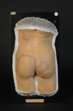 Lèpre anesthésique en cercles. Pays habité : l'île Bourbon. Homme âgé de 23 ans, employé