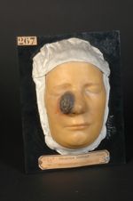Syphilis héréditaire. Gomme ulcérée avec destruction des os du nez. Femme âgée de 16 ans, couturière