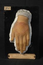 Trichophytie érythémato-vésiculeuse circinée du dos de la main. Homme âgé de 16 ans, garçon boucher