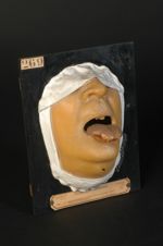 Gomme syphilitique ulcérée de la langue