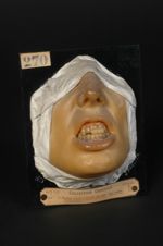 Erosions linéaires horizontales des dents. Sujet lupique. Homme âgé de 21 ans, serrurier