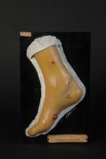 Sarcomatose de Kaposi (Inv. 1922). Sarcomatose généralisée ; sarcome fasciculé érectile. Homme âgé d [...]