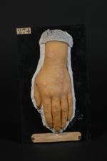 Erythème polymorphe circiné