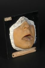 Ulcérations syphilitiques tertiaires de la langue. Homme âgé de 34 ans, forgeron