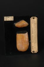 Gomme syphilitique de la langue. Homme âgé de 37 ans, cordonnier