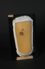 Gomme scrofulo-tuberculeuse de la cuisse. Homme âgé de 18 ans, boucher