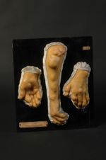 Goutte. Déformations diverses. Tophi