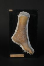 Varices lymphatiques ulcérées (Syn : Pachydermie lymphangiectasique de Rindfleisch Inv. 1889), d'ori [...]