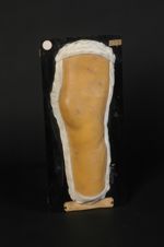 Zona purpurique du membre inférieur