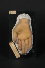 Lupus érythémateux de la paume de la main. Femme âgée de 37 ans, couturière