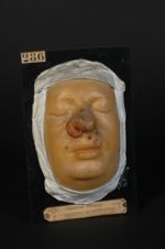 Chancre syphilitique de la racine du nez. Homme âgé de 38 ans, concierge