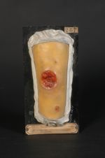 Ulcère simple de la jambe, simulant une gomme syphilitique ulcérée. Femme âgée de 25 ans, blanchisse [...]