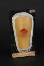 Ulcère simple de la jambe, simulant une gomme syphilitique ulcérée. Femme âgée de 25 ans, cuisinière