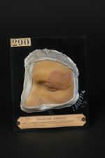 Lupus érythémato-tuberculeux de la paupière supérieure. Homme âgé de 30 ans, bijoutier