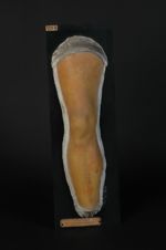 Prurigo lymphadénique (Inv. 1922). Homme âgé de 52 ans, boucher. Lichen ruber (?)