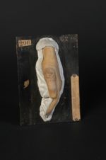 Tuberculose cutanée verruqueuse du pouce (Inv. 1889). Femme âgée de 34 ans, cultivatrice. Papillome  [...]