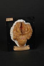 Tuberculose papillomateuse chez un syphilitique mort de tuberculose pulmonaire